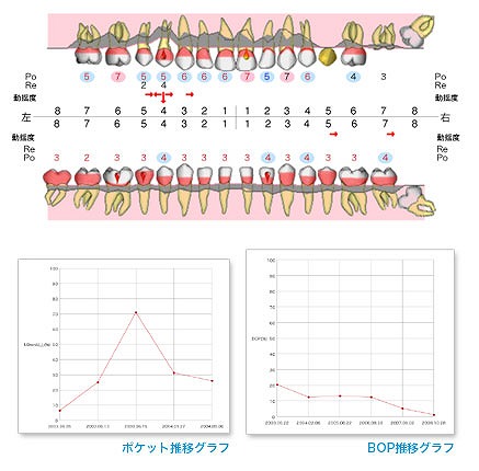 ⑤ 歯周病の検査(6点法)