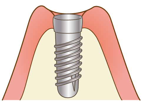 インプラント体を埋め込む
