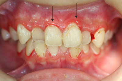 歯ぐきの腫れ・出血