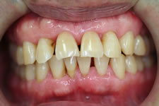 重度歯周炎の治療例