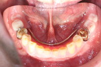 重度歯周炎の治療例