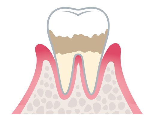 軽度歯周病