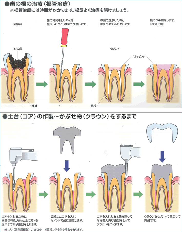 根 管 治療 蓋 を すると 痛い